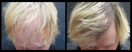 New York Hair Restoration Before And After Image